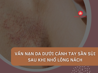 Cách trị vấn nạn da dưới cánh tay sần sùi sau khi nhổ lông nách