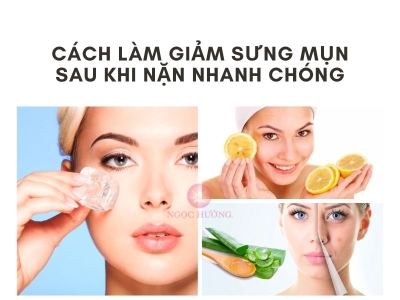 9 Cách làm giảm sưng đỏ sau khi nặn mụn nhanh chóng, hiệu quả