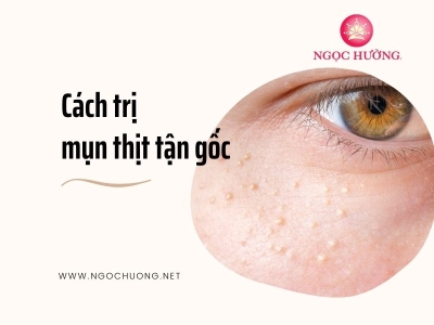 Cách Trị Mụn Thịt Dứt Điểm Tận Gốc Không Lo Tái Phát