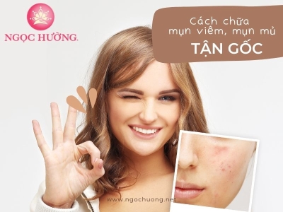 Bật Mí Cách Trị Mụn Viêm, Mụn Mủ Tận Gốc