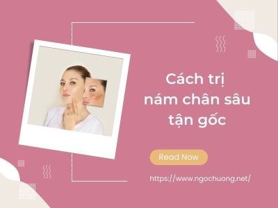 Nám chân sâu: Nguyên nhân, cách điều trị dứt điểm không tái phát