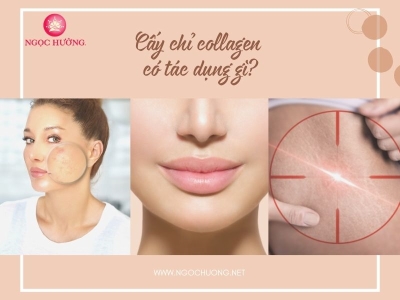 Cấy Chỉ Collagen Có Tác Dụng Gì? 7 Tác Dụng Ít Ai Biết