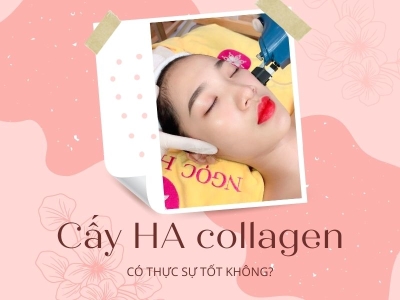 Cấy Ha Collagen Là Gì? Có Tốt Không? Giá Bao Nhiêu?