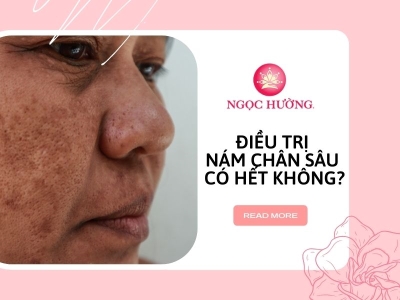 Điều Trị Nám Chân Sâu Bằng Tia Laser Xoá Tận Gốc, An Toàn Tuyệt Đối