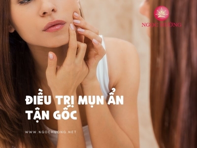 Cách Điều Trị Mụn Ẩn Tận Gốc, Hiệu Quả, Da Căng Sáng Mịn Màng