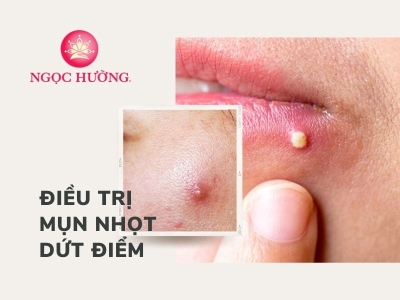 Cách Điều Trị Mụn Nhọt Dứt Điểm Không Đau Không Tái Phát