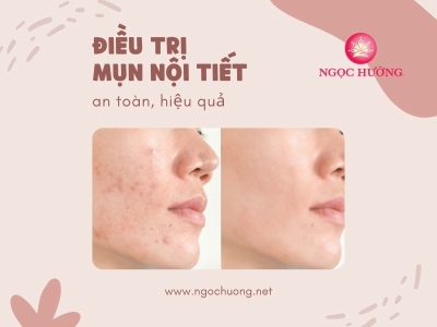 Cách Điều Trị Mụn Nội Tiết Dứt Điểm An Toàn Hiệu Quả