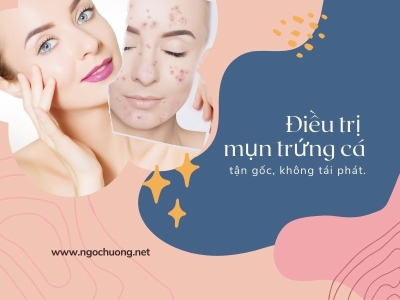 Cách Điều Trị Mụn Trứng Cá Tận Gốc Hiệu Quả Ngăn Ngừa Tái Phát