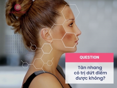 Tàn Nhang Có Trị Dứt Điểm Được Không? Giải Đáp Cùng Chuyên Gia