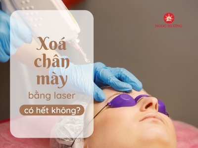 Xóa chân mày bằng laser có hết không?