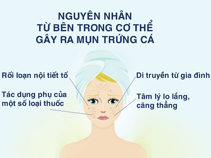 nguyên nhân gây ra mụn 