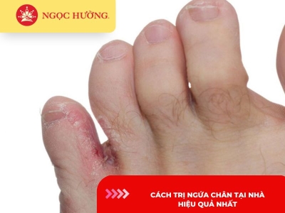 5 cách trị ngứa chân tại nhà hiệu quả trong 1 đêm