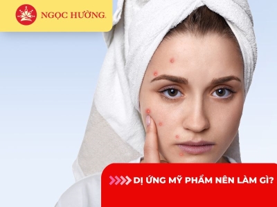 Dị ứng mỹ phẩm nên làm gì? 8 cách trị dị ứng mỹ phẩm tại nhà hiệu quả