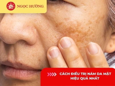 Cách điều trị nám da mặt từ bên trong hiệu quả sau 4 lần điều trị