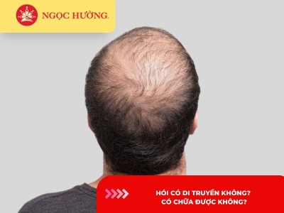 Hói có di truyền không? Có chữa được không?