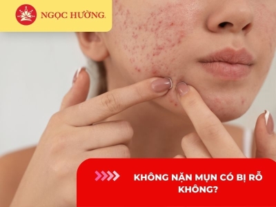 Không nặn mụn có bị rỗ không? 5 cách để da mụn không rỗ hiệu quả