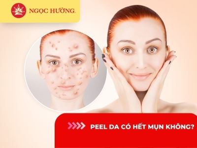 Sự thật Peel da có hết mụn không? Có nên peel da khi bị mụn không?