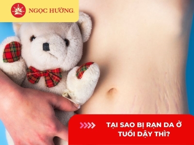 Tại sao bị rạn da ở tuổi dậy thì? Rạn da ở tuổi dậy thì có hết không?