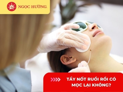 Tẩy nốt ruồi rồi có mọc lại không? Mọc lại có to hơn không?