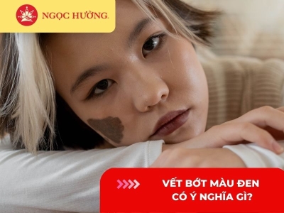 Vết bớt màu đen có ý nghĩa gì? Có nên xóa vết bớt màu đen không?