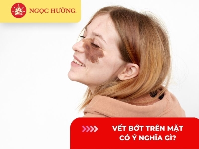 Vết bớt trên mặt có ý nghĩa gì? Giải mã 7 ý nghĩa vết bớt trên mặt