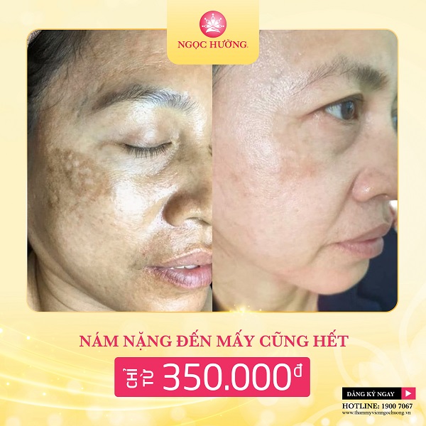 Bẻ gãy liên kết - Hủy diệt nám tận gốc 