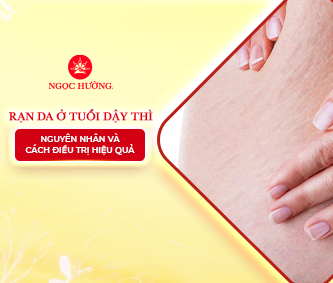 Rạn da ở tuổi dậy thì: Nguyên nhân và cách điều trị hiệu quả