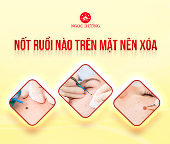 Nốt Ruồi Nào Trên Mặt Nên Xóa? Cách Nhận Biết Và Giải Pháp An Toàn
