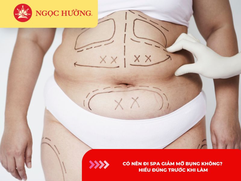 Có nên đi spa giảm mỡ bụng không? Hiểu đúng trước khi làm