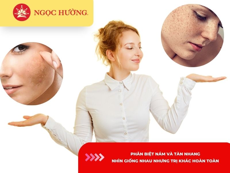 Phân biệt nám và tàn nhang: Nhìn giống nhau nhưng trị khác hoàn toàn
