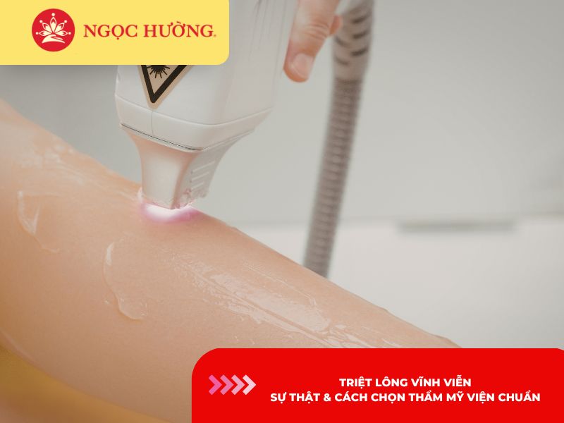 Triệt lông vĩnh viễn: Sự thật & cách chọn thẩm mỹ viện chuẩn