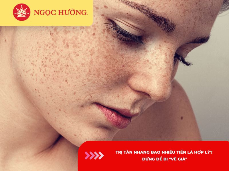 Trị tàn nhang bao nhiêu tiền là hợp lý? Đừng để bị Vẽ Giá