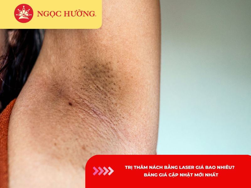 Trị thâm nách bằng laser giá bao nhiêu? Bảng giá cập nhật 2026